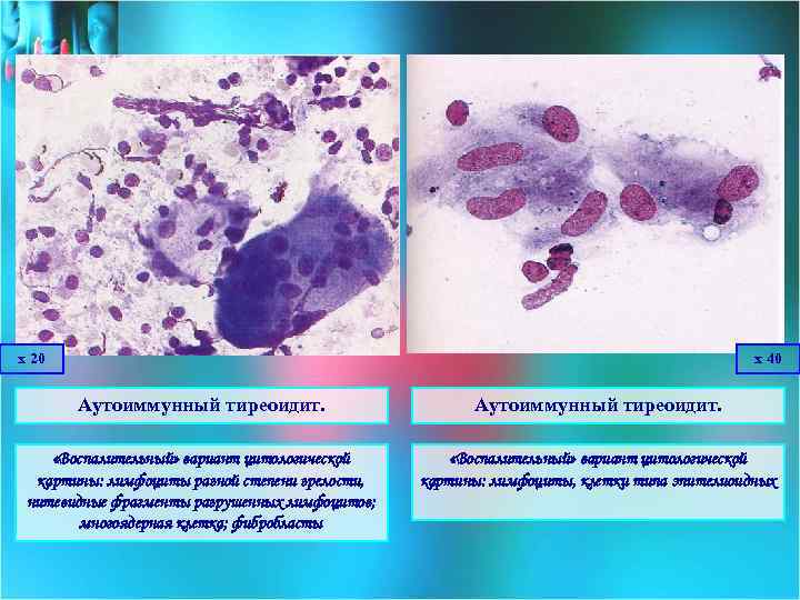 Цитологическая картина аутоиммунного тиреоидита
