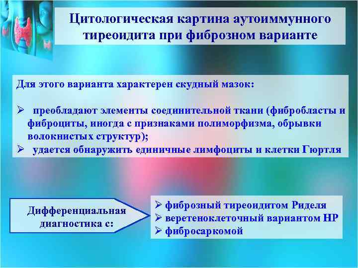 Цитологическая картина аутоиммунного тиреоидита при фиброзном варианте Для этого варианта характерен скудный мазок: Ø