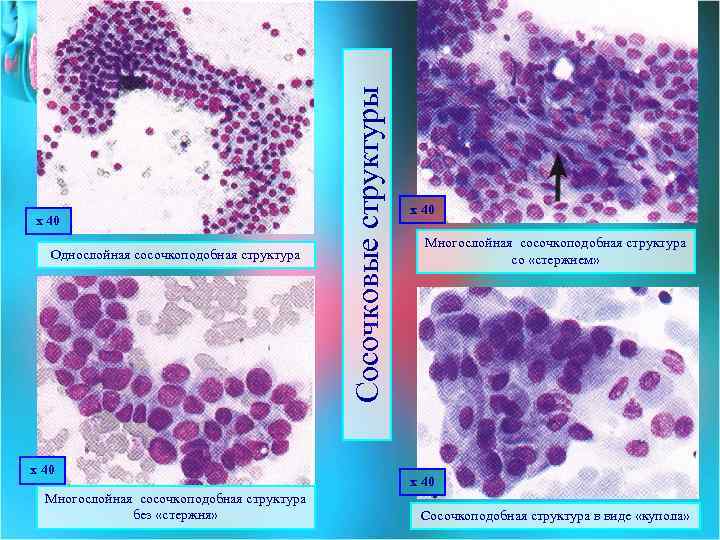 Однослойная сосочкоподобная структура х 40 Многослойная сосочкоподобная структура без «стержня» Сосочковые структуры х 40