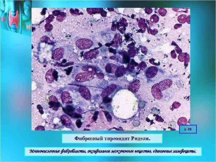 х 40 Фиброзный тиреоидит Риделя. Многочисленные фибробласты, оксифильное межуточное вещество, единичные лимфоциты. 