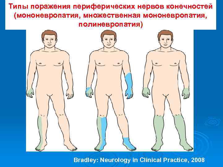 Типы поражения периферических нервов конечностей (мононевропатия, множественная мононевропатия, полиневропатия) Bradley: Neurology in Clinical Practice,