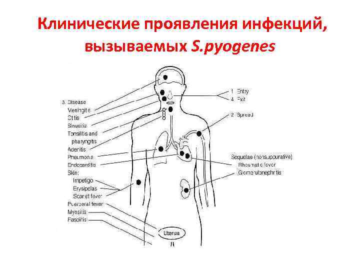 Клинические проявления инфекций, вызываемых S. pyogenes 