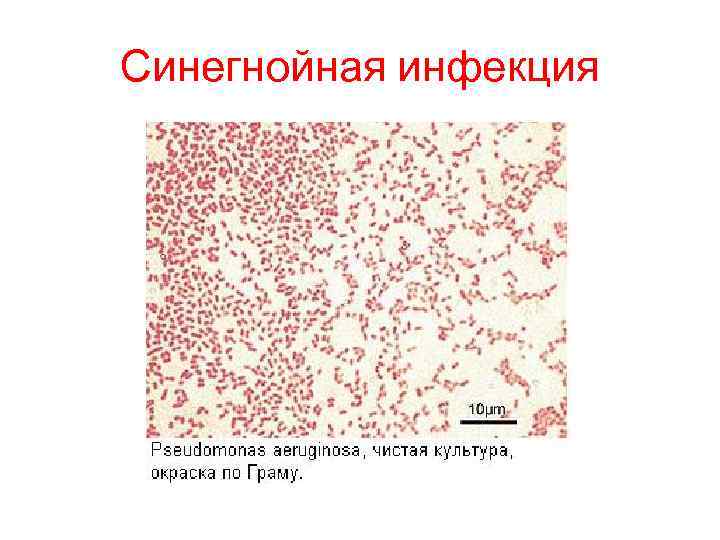 Синегнойная инфекция 
