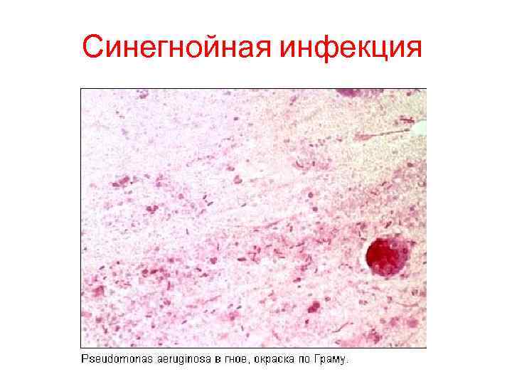 Синегнойная инфекция 