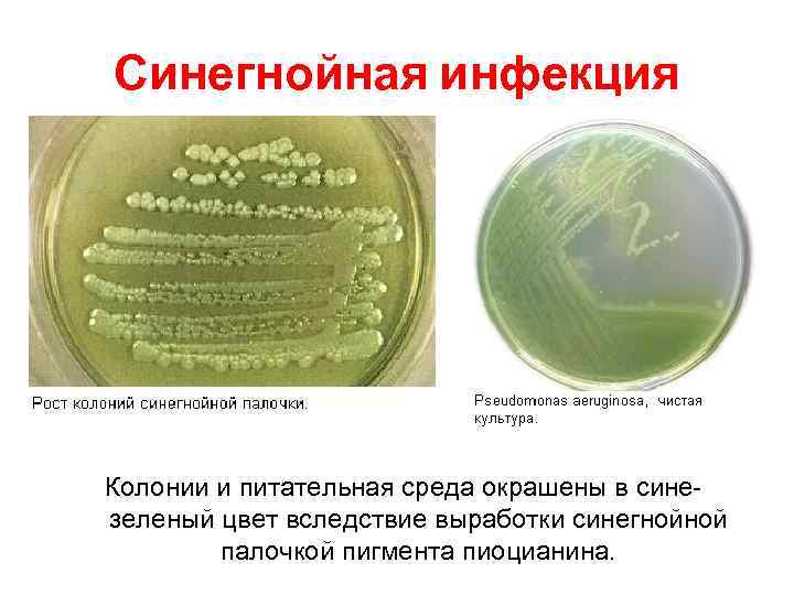 Синегнойная инфекция Колонии и питательная среда окрашены в синезеленый цвет вследствие выработки синегнойной палочкой