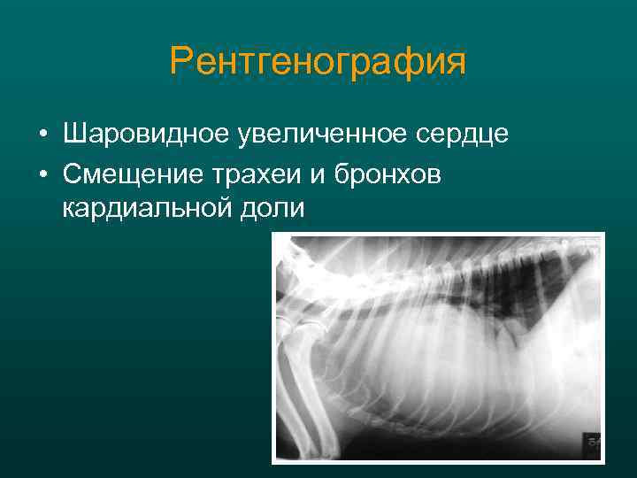 Рентгенография • Шаровидное увеличенное сердце • Смещение трахеи и бронхов кардиальной доли 