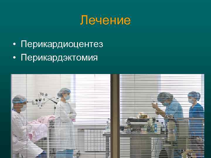Лечение • Перикардиоцентез • Перикардэктомия 