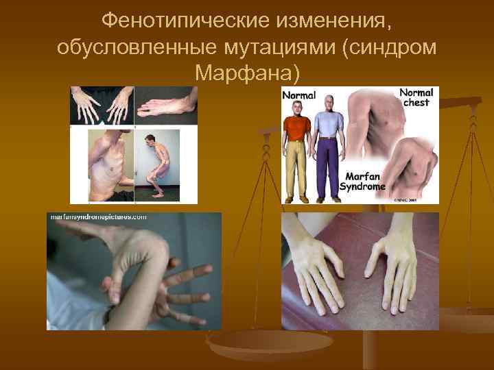 Фенотипические изменения, обусловленные мутациями (синдром Марфана) 