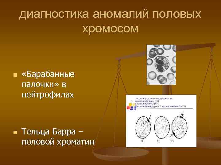 диагностика аномалий половых хромосом n n «Барабанные палочки» в нейтрофилах Тельца Барра – половой