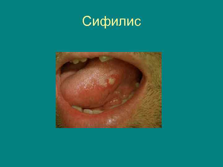 Сифилис 