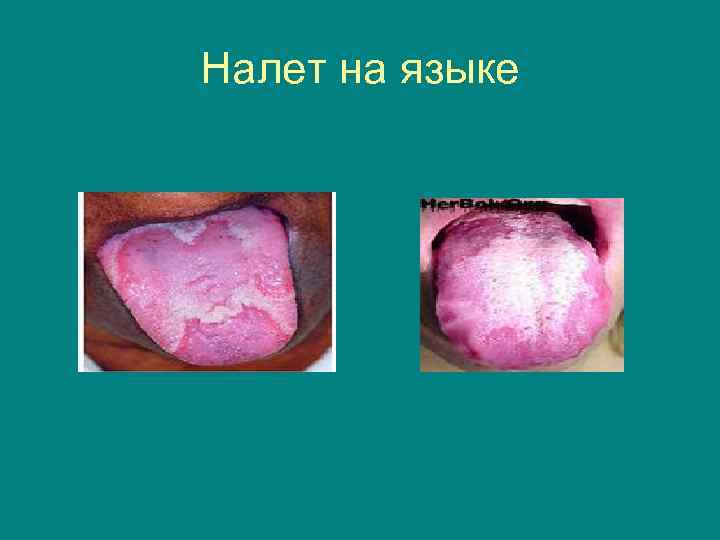 Налет на языке 