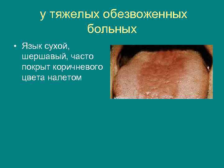 у тяжелых обезвоженных больных • Язык сухой, шершавый, часто покрыт коричневого цвета налетом 