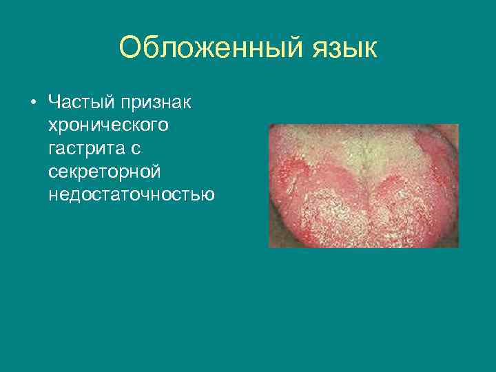 Обложенный язык • Частый признак хронического гастрита с секреторной недостаточностью 