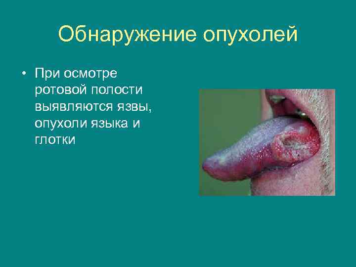 Обнаружение опухолей • При осмотре ротовой полости выявляются язвы, опухоли языка и глотки 