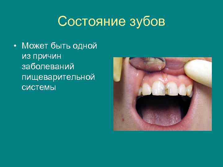 Состояние зубов • Может быть одной из причин заболеваний пищеварительной системы 