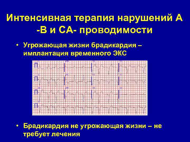 Интенсивная терапия нарушений А -В и СА- проводимости • Угрожающая жизни брадикардия – имплантация