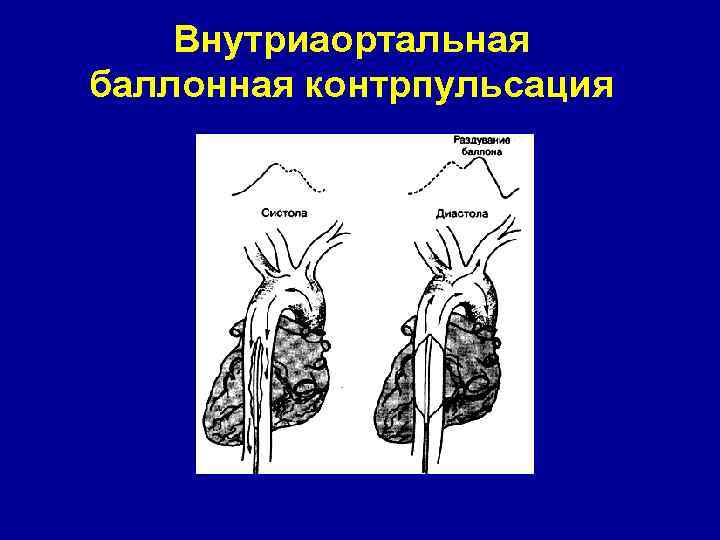 Внутриаортальная баллонная контрпульсация 
