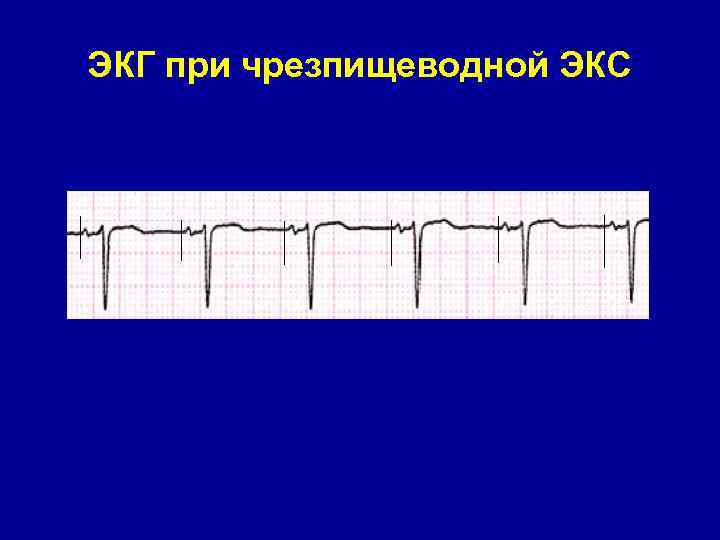 ЭКГ при чрезпищеводной ЭКС 
