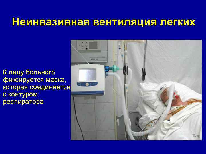 Неинвазивная вентиляция легких К лицу больного фиксируется маска, которая соединяется с контуром респиратора 