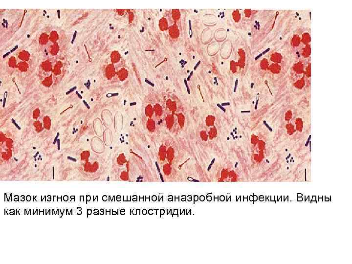 Мазок изгноя при смешанной анаэробной инфекции. Видны как минимум 3 разные клостридии. 