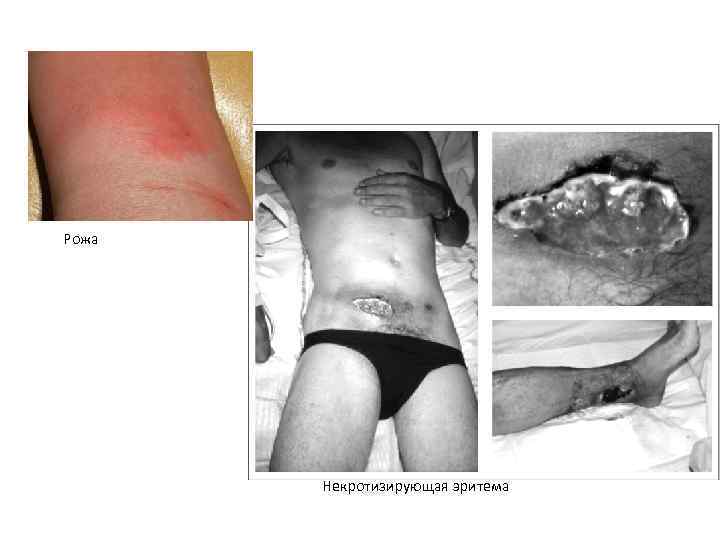 Рожа Некротизирующая эритема 