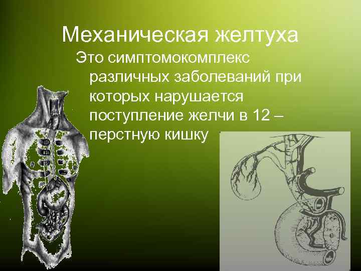Механическая желтуха Это симптомокомплекс различных заболеваний при которых нарушается поступление желчи в 12 –
