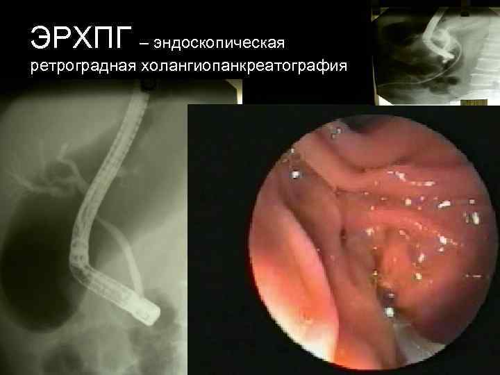 ЭРХПГ – эндоскопическая ретроградная холангиопанкреатография 