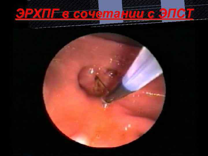 ЭРХПГ в сочетании с ЭПСТ 