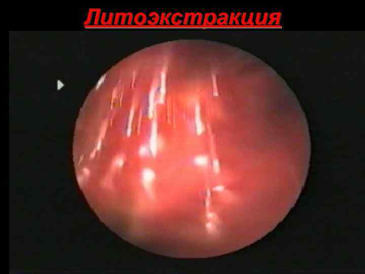 Литоэкстракция 