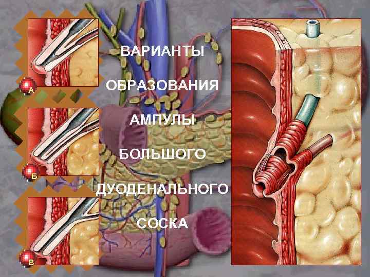 ВАРИАНТЫ А ОБРАЗОВАНИЯ АМПУЛЫ БОЛЬШОГО Б ДУОДЕНАЛЬНОГО СОСКА В 