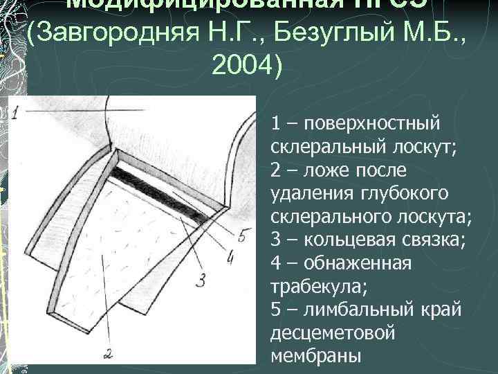 Модифицированная НГСЭ (Завгородняя Н. Г. , Безуглый М. Б. , 2004) 1 – поверхностный