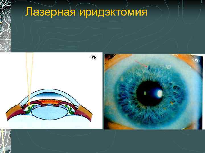 Лазерная иридэктомия. Лазерная периферическая иридэктомия. Лазерная периферическая иридэктомия (глаукома). Лазерная иридотомия при глаукоме. Лазерная базальная иридэктомия.