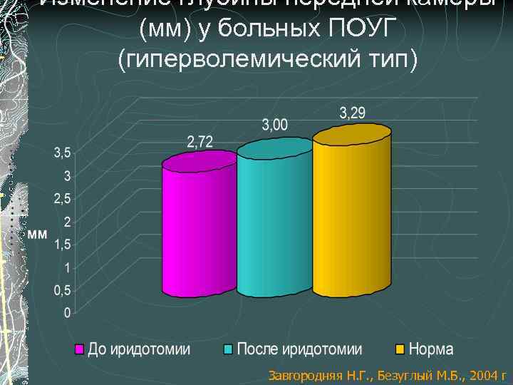 Изменение глубины передней камеры (мм) у больных ПОУГ (гиперволемический тип) Завгородняя Н. Г. ,