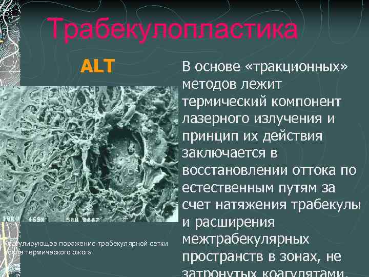 Трабекулопластика ALT Коагулирующее поражение трабекулярной сетки после термического ожога В основе «тракционных» методов лежит