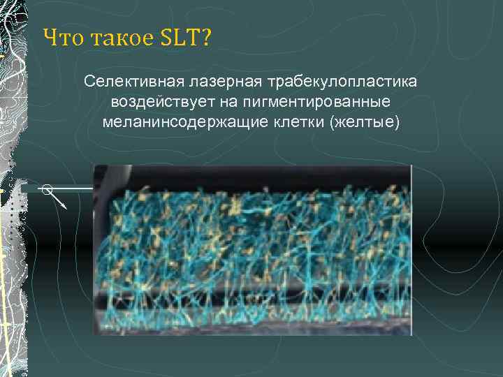 Что такое SLT? Селективная лазерная трабекулопластика воздействует на пигментированные меланинсодержащие клетки (желтые) 