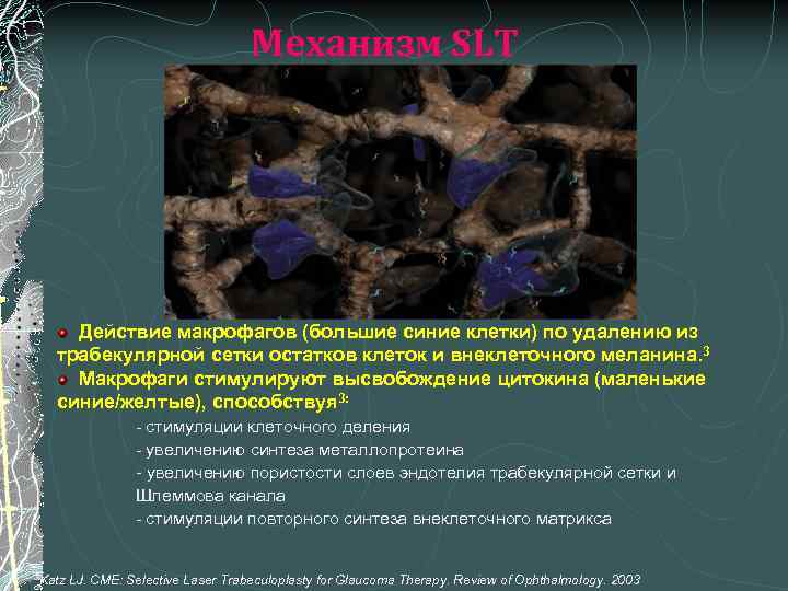 Механизм SLT Действие макрофагов (большие синие клетки) по удалению из трабекулярной сетки остатков клеток