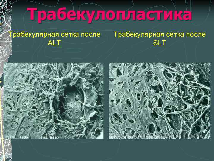 Трабекулопластика Трабекулярная сетка после ALT Трабекулярная сетка после SLT 
