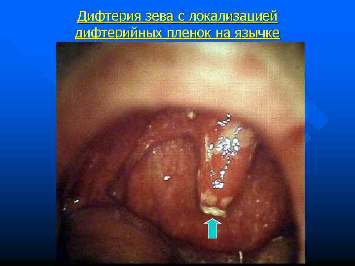 Дифтерия зева с локализацией дифтерийных пленок на язычке 