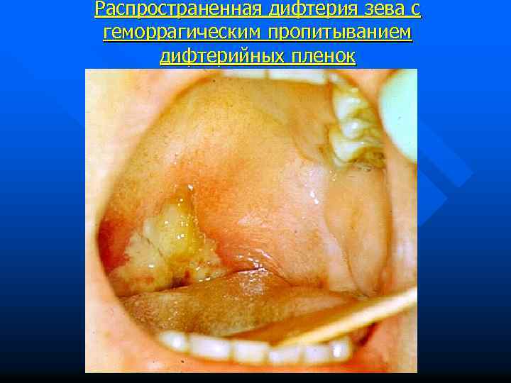 Распространенная дифтерия зева с геморрагическим пропитыванием дифтерийных пленок 