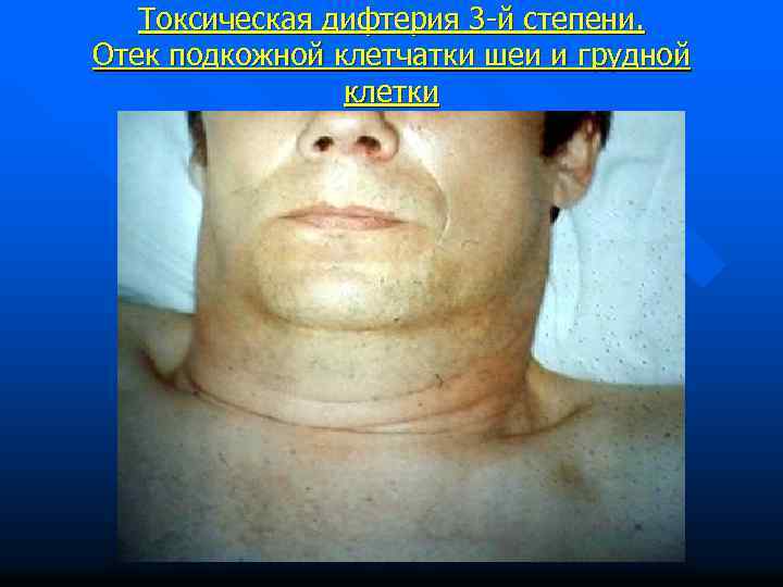 Токсическая дифтерия 3 -й степени. Отек подкожной клетчатки шеи и грудной клетки 
