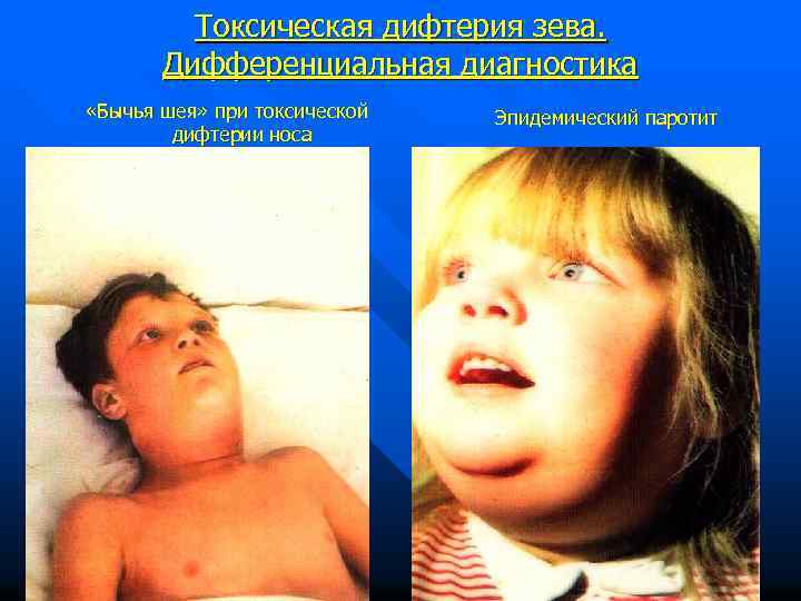 Токсическая дифтерия зева. Дифференциальная диагностика «Бычья шея» при токсической дифтерии носа Эпидемический паротит 