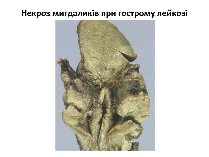 Некроз мигдаликів при гострому лейкозі 