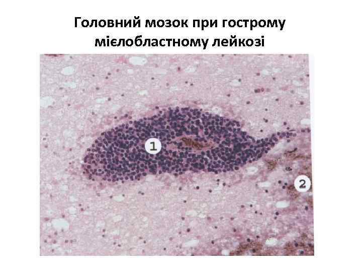 Головний мозок при гострому мієлобластному лейкозі 