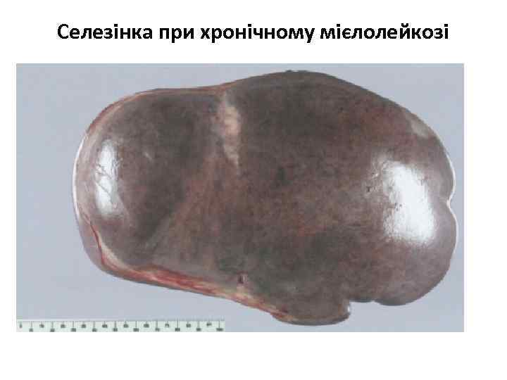 Селезінка при хронічному мієлолейкозі 