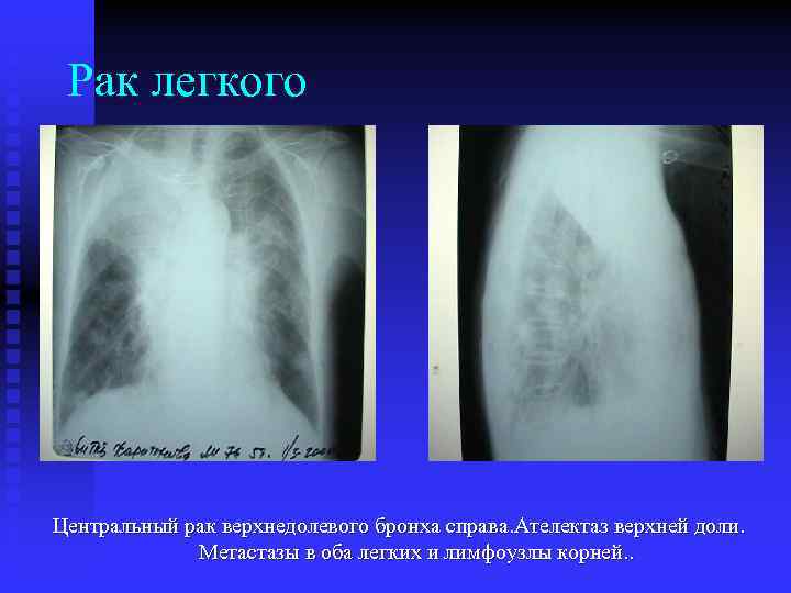 Рак легкого Центральный рак верхнедолевого бронха справа. Ателектаз верхней доли. Метастазы в оба легких