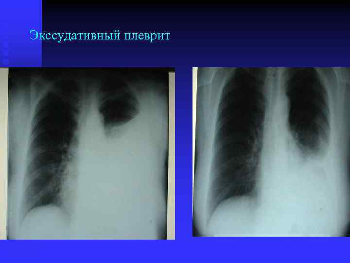 Экссудативный плеврит 