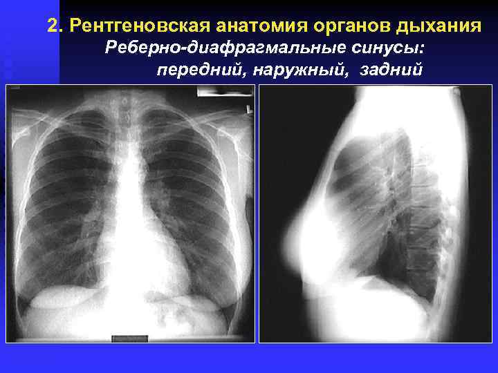 2. Рентгеновская анатомия органов дыхания Реберно-диафрагмальные синусы: передний, наружный, задний 