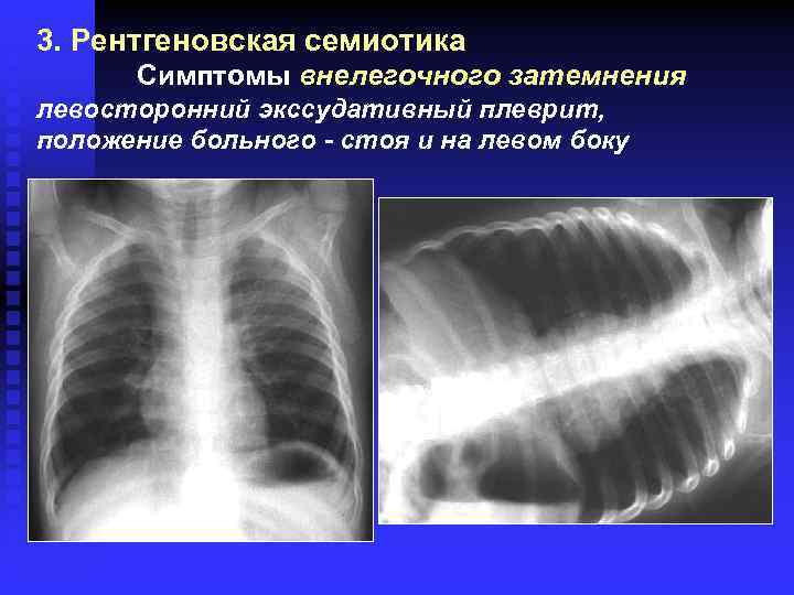 3. Рентгеновская семиотика Симптомы внелегочного затемнения левосторонний экссудативный плеврит, положение больного - стоя и