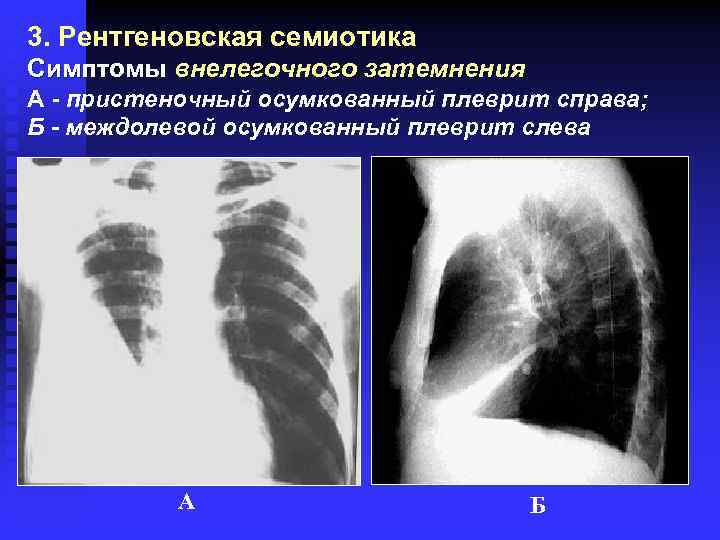 3. Рентгеновская семиотика Симптомы внелегочного затемнения А - пристеночный осумкованный плеврит справа; Б -