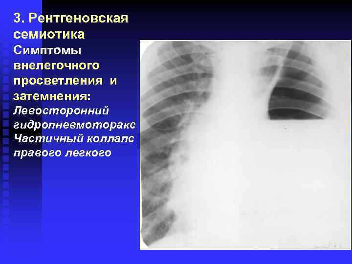 3. Рентгеновская семиотика Симптомы внелегочного просветления и затемнения: Левосторонний гидропневмоторакс Частичный коллапс правого легкого